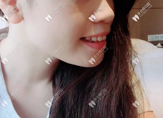 骨性嘴凸佩戴第39幅牙套側臉變化很大