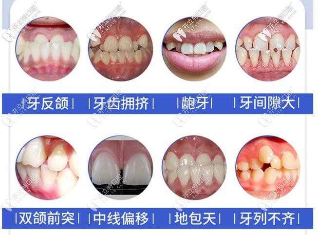 想知道重慶時代天使矯正價格嗎？世紀美奧口腔活動價19800