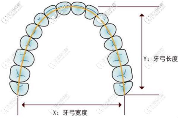 8-14歲的兒童使用牙齒擴(kuò)弓的費(fèi)用大概是多少？