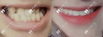 黃醫(yī)生：地包天、反頜復(fù)雜案例矯正