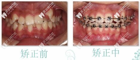 張醫(yī)生：牙齒參差不齊，正在矯正中