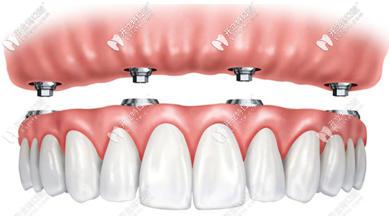 廣州半口種植牙價(jià)格