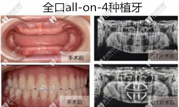 深圳美萊口腔周煒院長全口種植牙<span style=