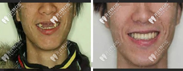 ALL- on-4種植牙技術(shù)修復