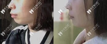 深覆合、齙牙顧客—拔牙7顆做的美國(guó)進(jìn)口自鎖金屬托槽