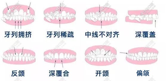  渭南牙科做牙齒矯正多少錢？想知道隱形和金屬矯正的價格