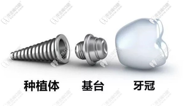 種植牙由種植牙、基臺及牙冠組成