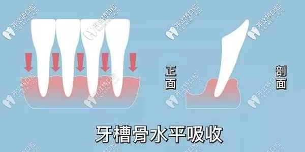 牙槽骨會(huì)慢慢吸收示意圖