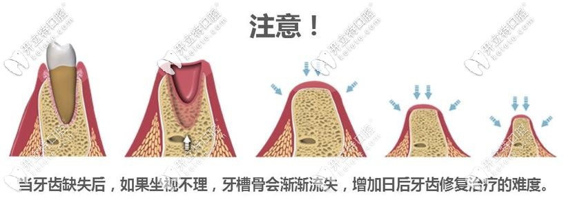 牙槽骨萎縮過程示意圖
