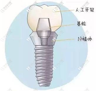 種植體的組成部分
