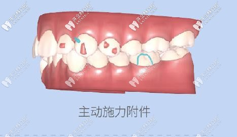 附件會對牙齒進(jìn)行施力