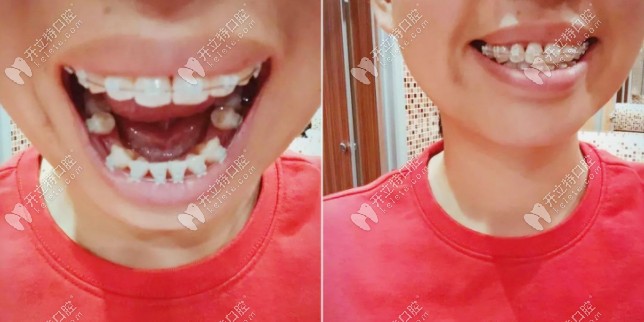 還在戴牙套中