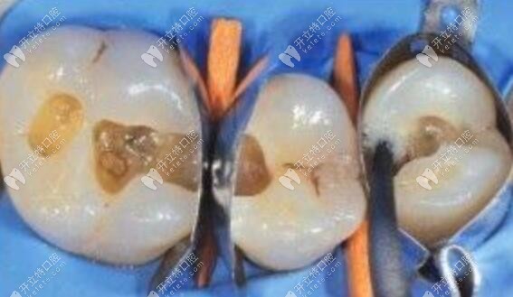 牙齒缺損補(bǔ)牙前