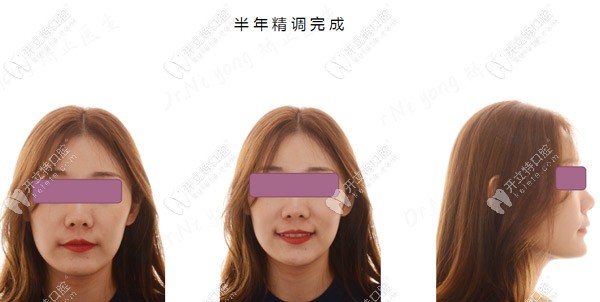 過了半年了，臉型還是有點(diǎn)變化的喲