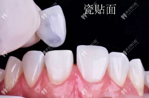 瓷貼面修復(fù)過程圖