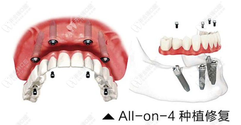 Allon4即刻種植牙技術(shù)