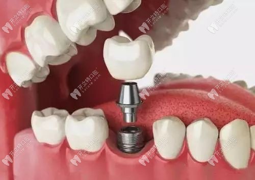 即刻負(fù)重為什么能當(dāng)天戴牙