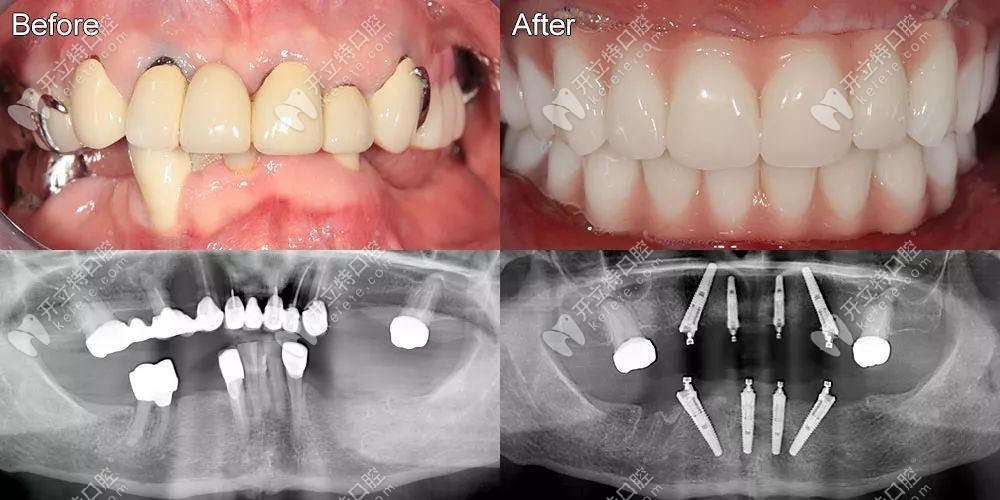 即刻負重4顆和6顆的真實區(qū)別已發(fā)放,它的優(yōu)勢是當天戴牙冠
