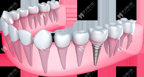 即刻負(fù)重種植牙的優(yōu)勢(shì)