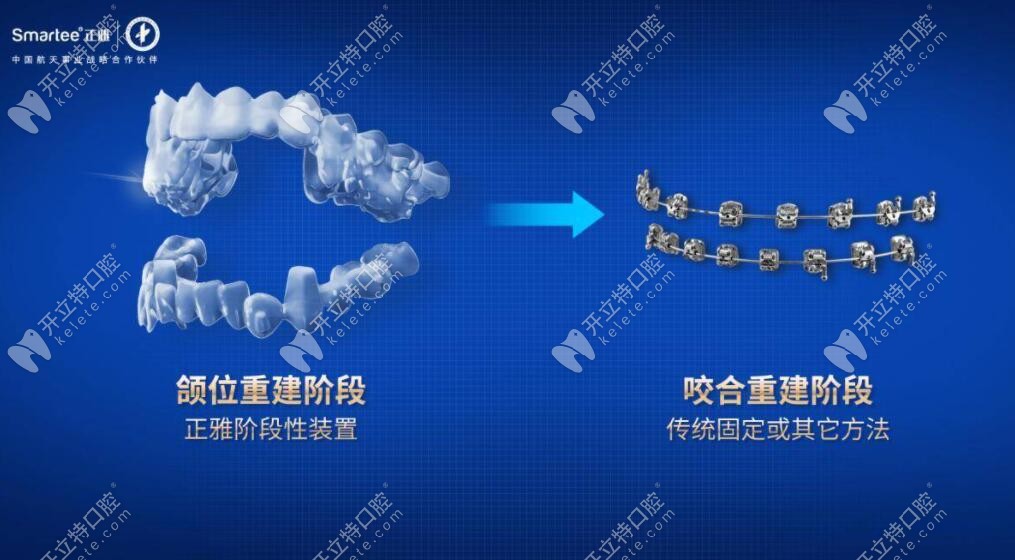 正雅S8S9頜位重建系列