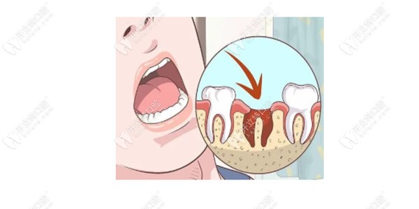 拔牙后留下的牙洞多長(zhǎng)時(shí)間可以長(zhǎng)平