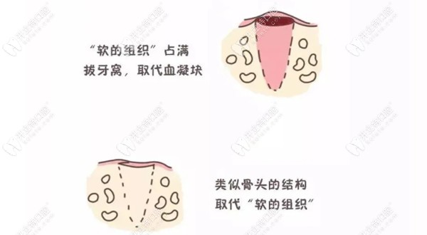 拔牙后的恢復(fù)過(guò)程