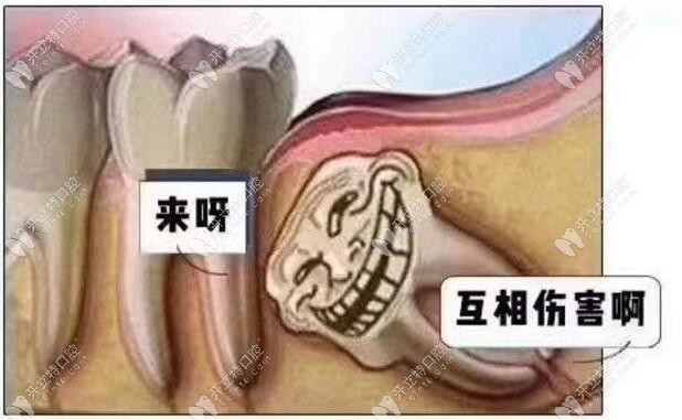 侵犯鄰牙（緊跟牙）：容易引起牙周炎