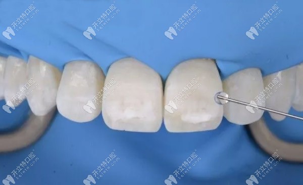 斑點還是存在，需要進一步酸蝕