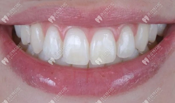 滲透樹脂治療氟斑牙的效果圖
