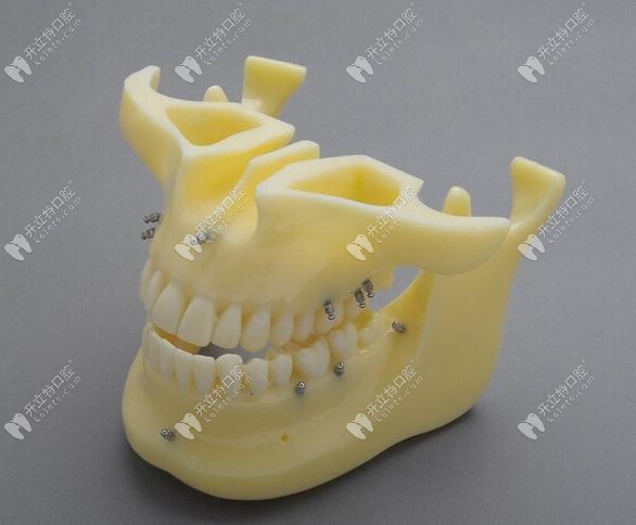 支抗釘在矯正過程中可適用的位置