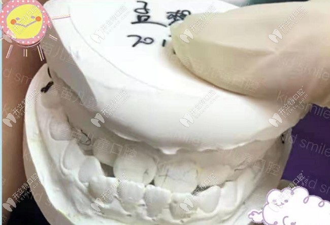 雖然羅慕矯正器費用貴,但兒子地包天戴了8個月效果就出來了