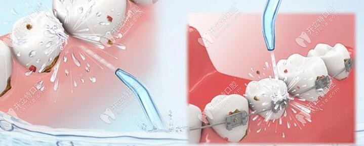 洗牙可是不會(huì)疼的，就是有點(diǎn)小麻