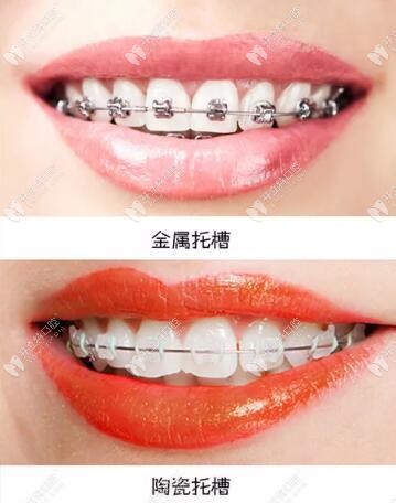 固定和隱形矯治器優(yōu)缺點(diǎn)大pk,矯治時(shí)間和結(jié)束效果一樣嗎?