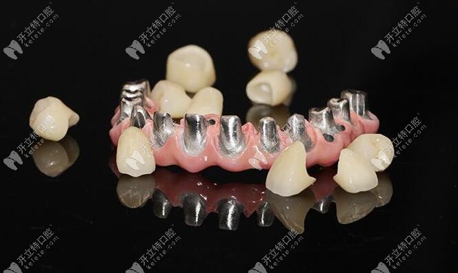 為了研究馬龍橋種植修復(fù)是什么,我把優(yōu)缺點(diǎn)和原理都搞懂了