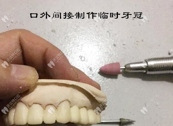 口外間接制作臨時牙冠