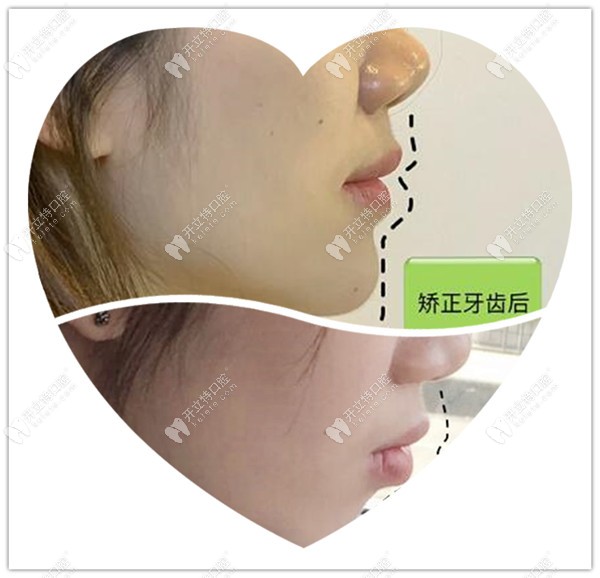 齙牙凸嘴牙齒矯正前后對(duì)比