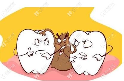 塞牙導致食物鑲嵌