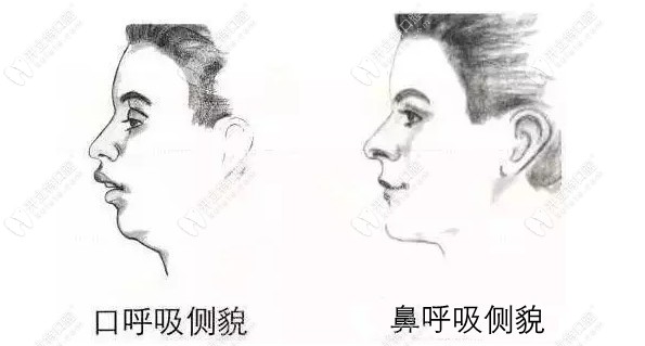 口呼吸和鼻呼吸的側(cè)貌對(duì)比