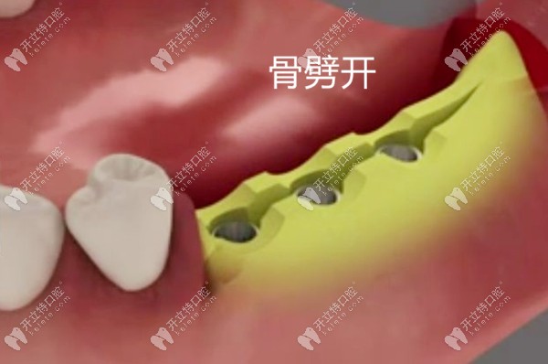 骨劈開術(shù)過程演示