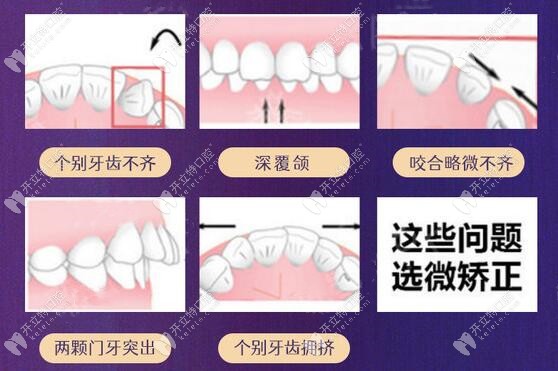 美加牙齒矯正的適應(yīng)癥狀