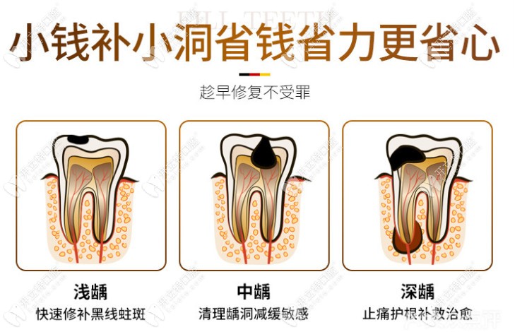 廣州天河柏德口腔補牙優(yōu)惠