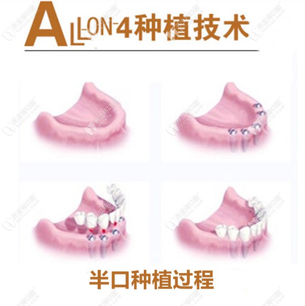 在廣州好大夫做ALL-on-4種植的過程圖