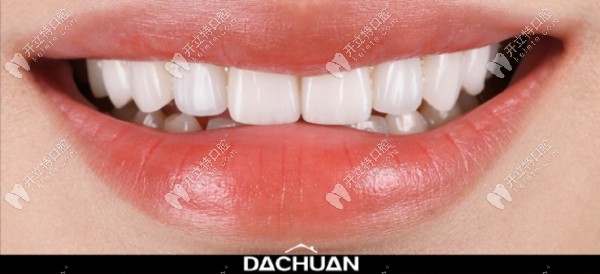 瓷貼面效果棒棒噠