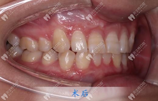 取下牙套后牙齒變整齊啦 取下牙套后牙齒變整齊啦