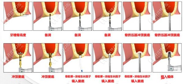 骨膠原和濃縮生長因子
