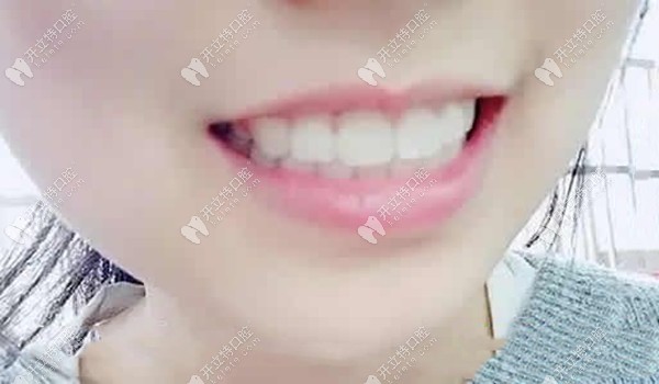 矯正后的效果