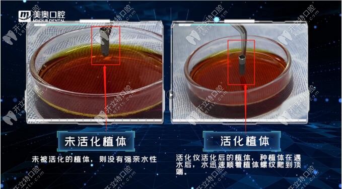 植立刻高疑難種植術(shù)15分鐘可將普通植體變成親水植體,那.....