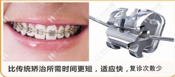 美國damon自鎖托槽快速矯正的技術(shù)原理