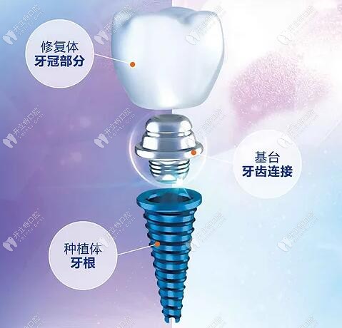 種植牙的組成