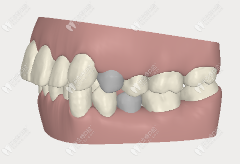 上頜前突癥狀示意圖